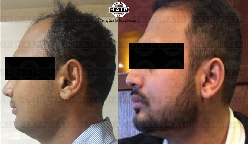 Beard Transplant in Mumbai