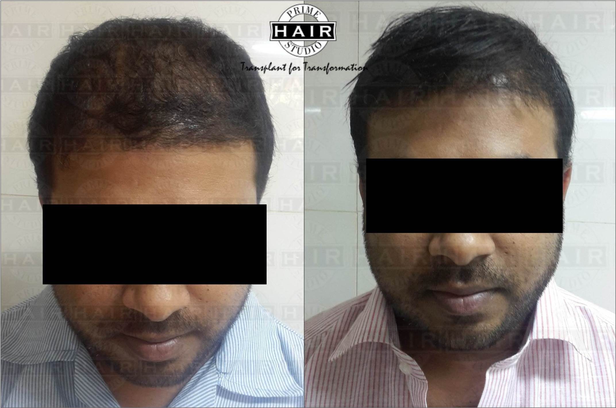 Hair Transplant Archives - Prime Hair Studio & Cosmetic Clinic