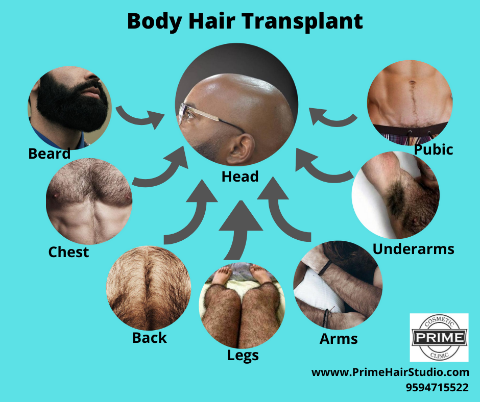 Body Hair Transplant in Mumbai