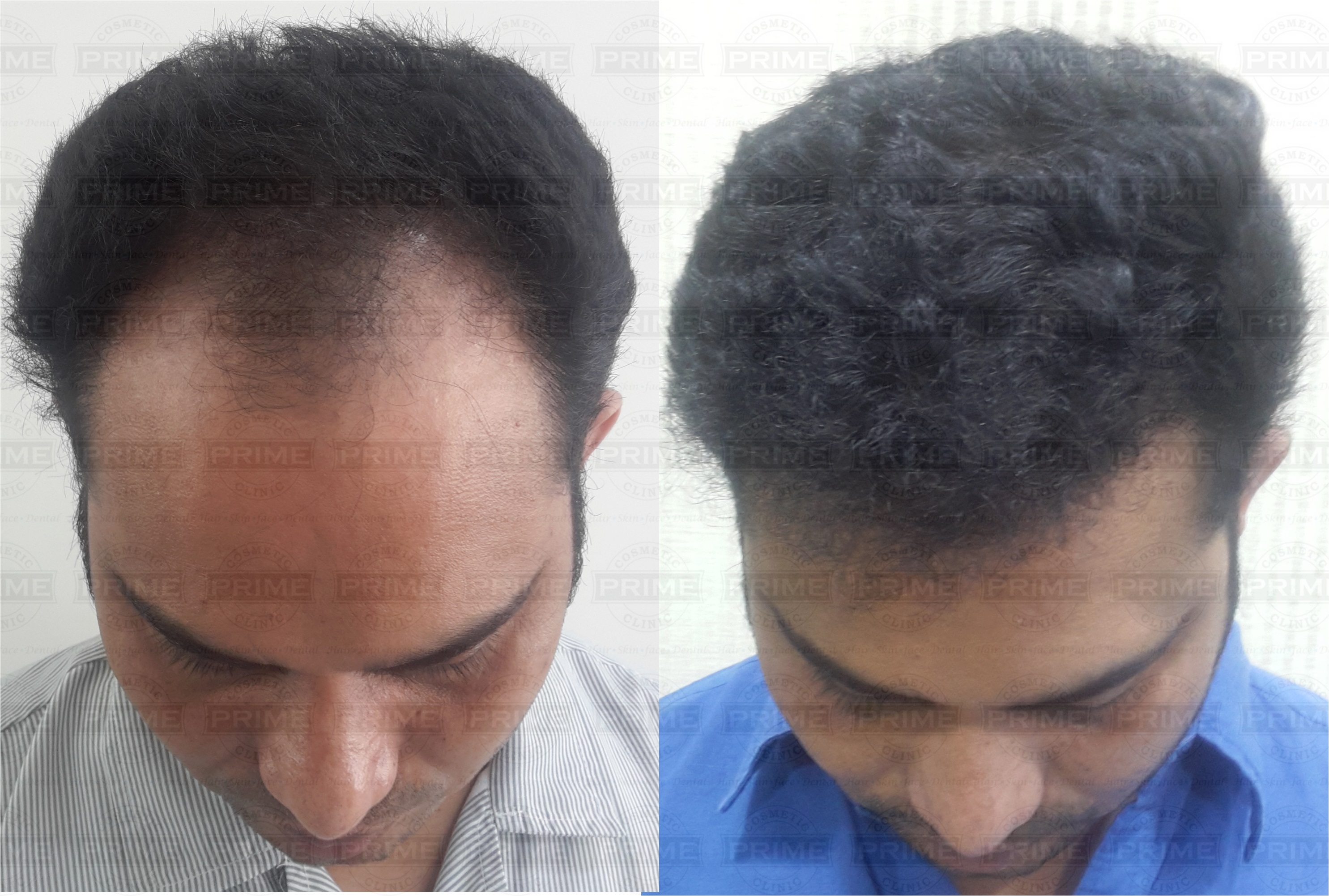 Hair transplant cost in Mumbai - Hair Transplant India - Prime Hair Studio