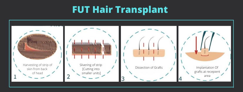 FUT Hair Transplant in mumbai with best results
