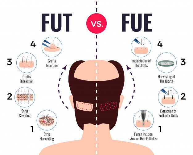 FUT vs FUE Which one is better?