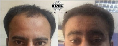 Hair Transplant 8 months Result
