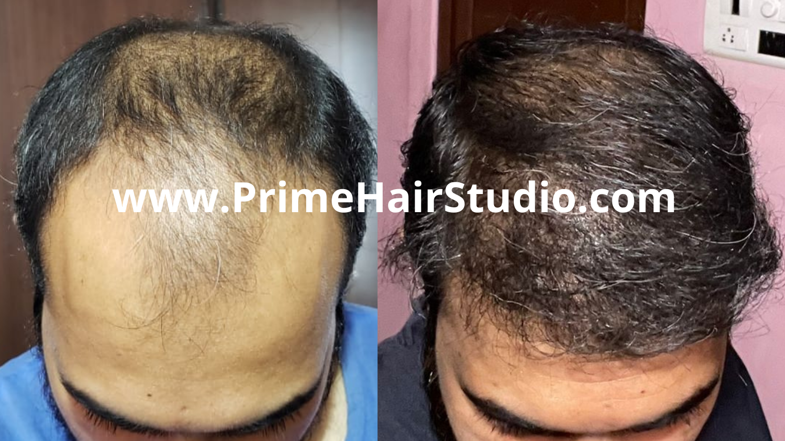 Hair Transplant Results - Before and After - Prime Hair Studio, Mumbai, India