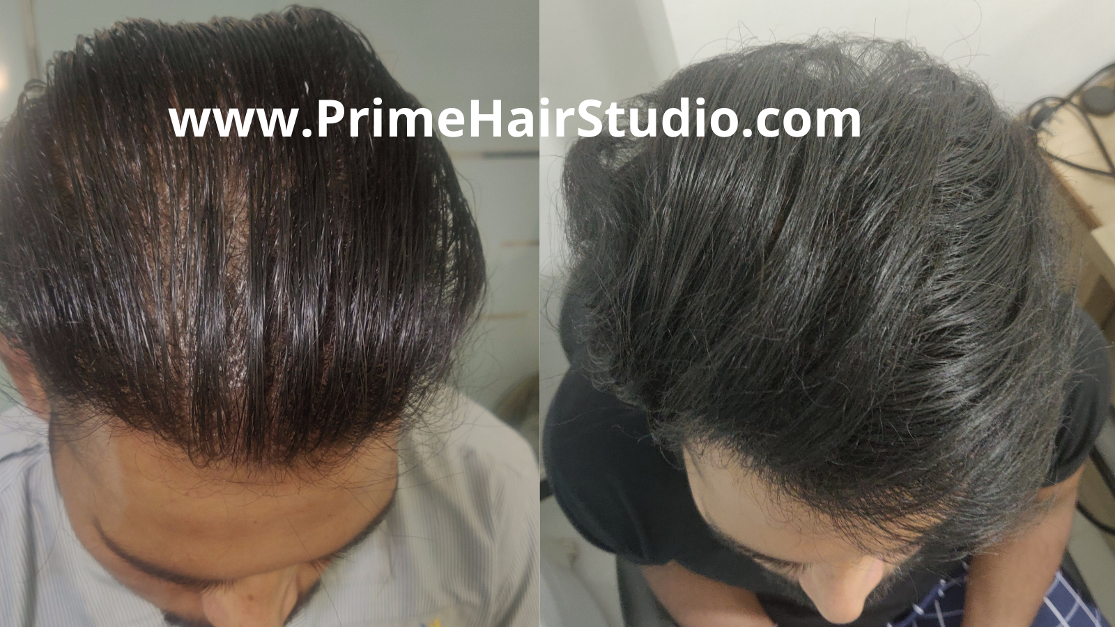 Biofibre Hair Implant Before and After - Prime Hair Studio & Cosmetic Clinic