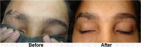 Eyebrow Transplant, Eyebrow Reconstruction