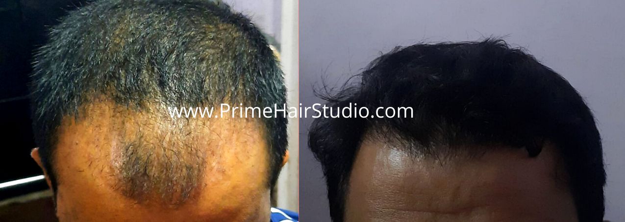 Hair Transplant at Prime Hair Studio - Call 9594715522