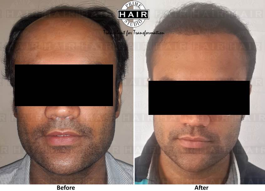 Cost of Hair Transplant in Mumbai, India - Prime Hair Studio