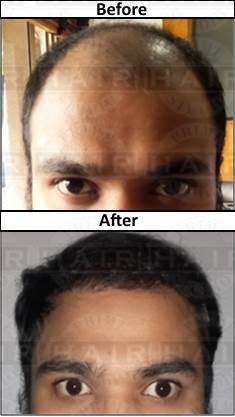 How to select Hair Transplant Clinic - Scalp Tricopigmentation - Prime Hair  Studio