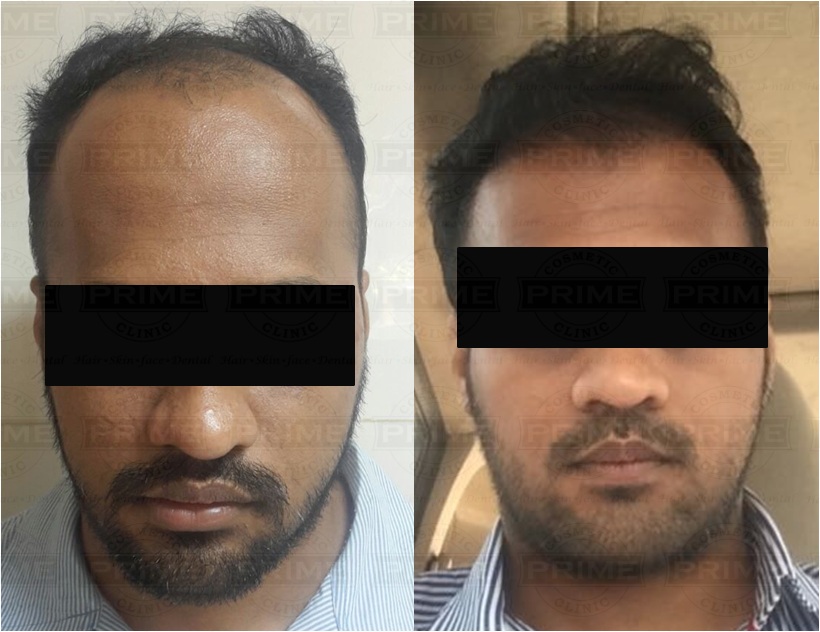 Cost of hair transplant in mumbai