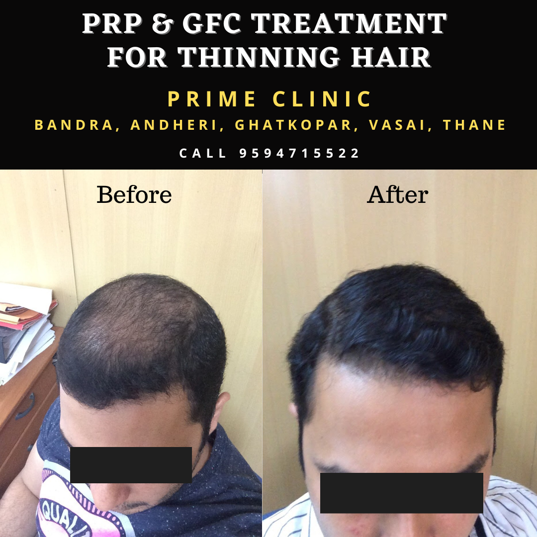 GFC Treatment for Hair at Prime Clinics