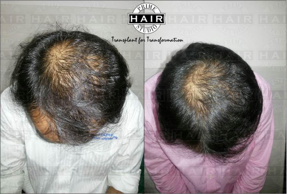 Hair Regrowth by PRP Therapy Result