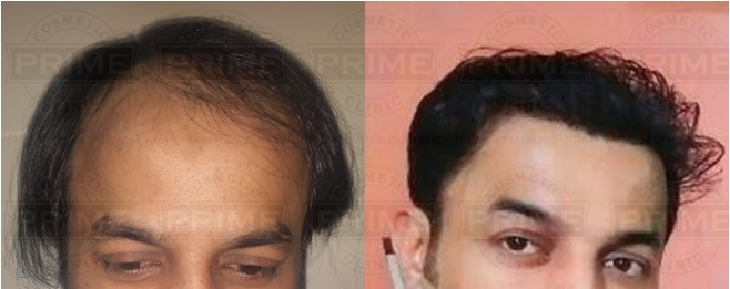 hair transplant cost in India