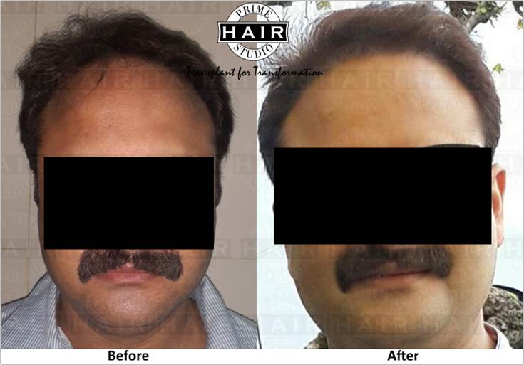 Best Hair Transplant in Mumbai 