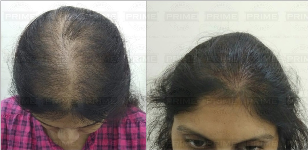Biofibres Hair Implant before and after results photo - Medicap, Biofibres in Mumbai