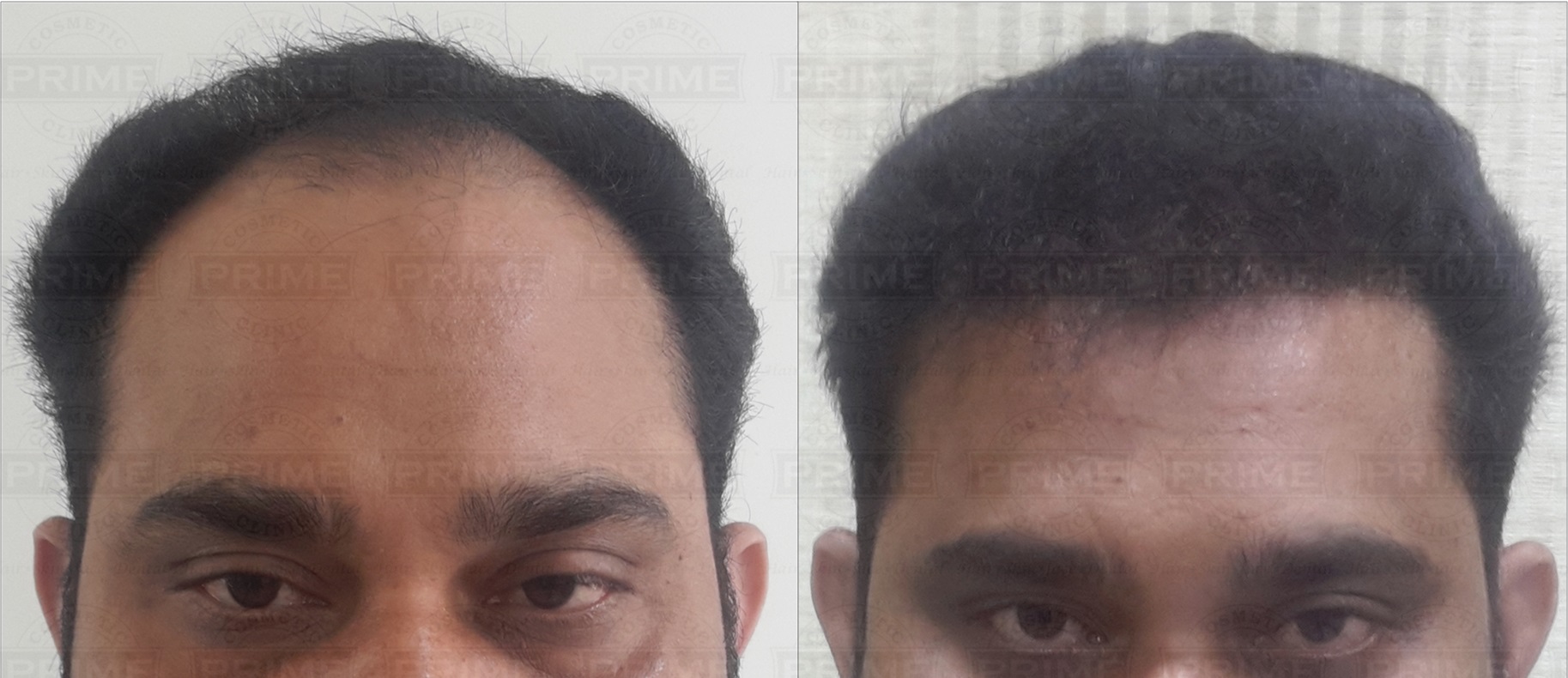 Hair Transplant in Mumbai