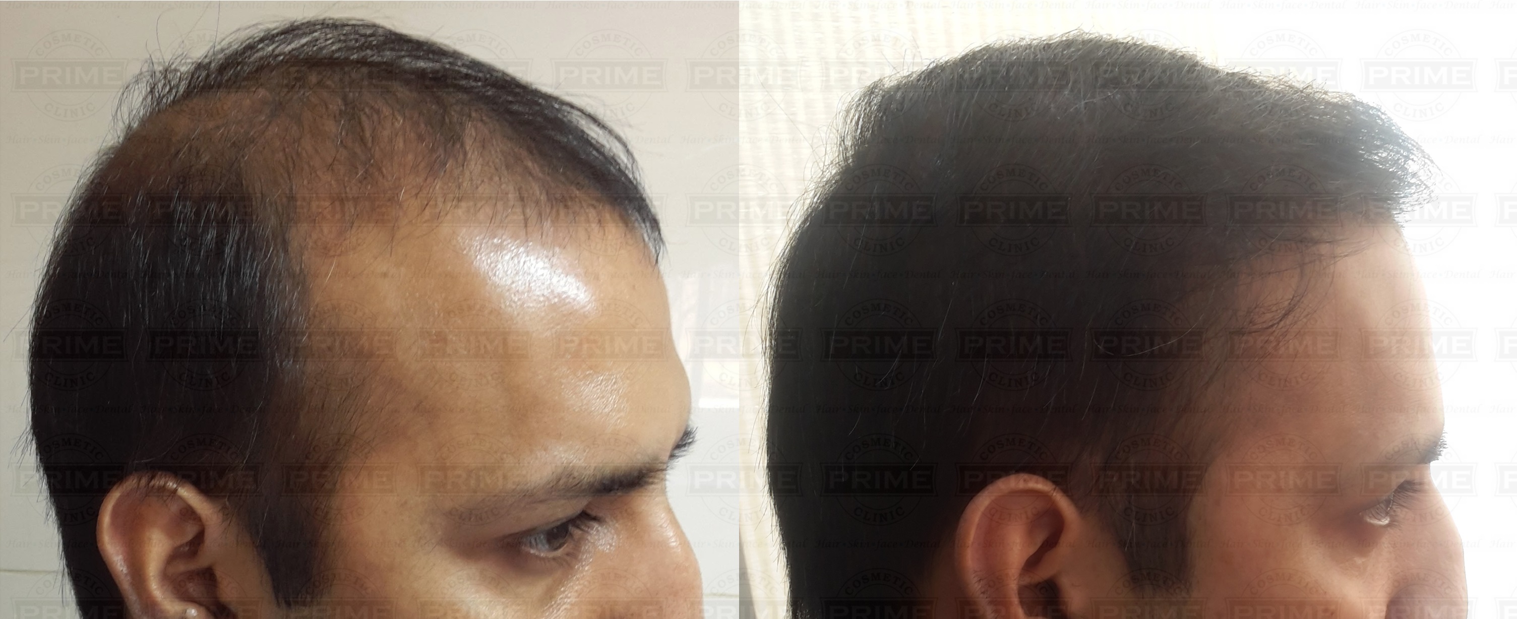 Biofibre Hair Implant Before and After - Prime Hair Studio & Cosmetic Clinic