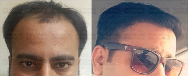 Cost of Hair transplant in India