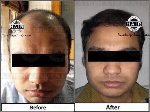 Bio-FUE hair transplant in Mumbai - Prime Hair Studio