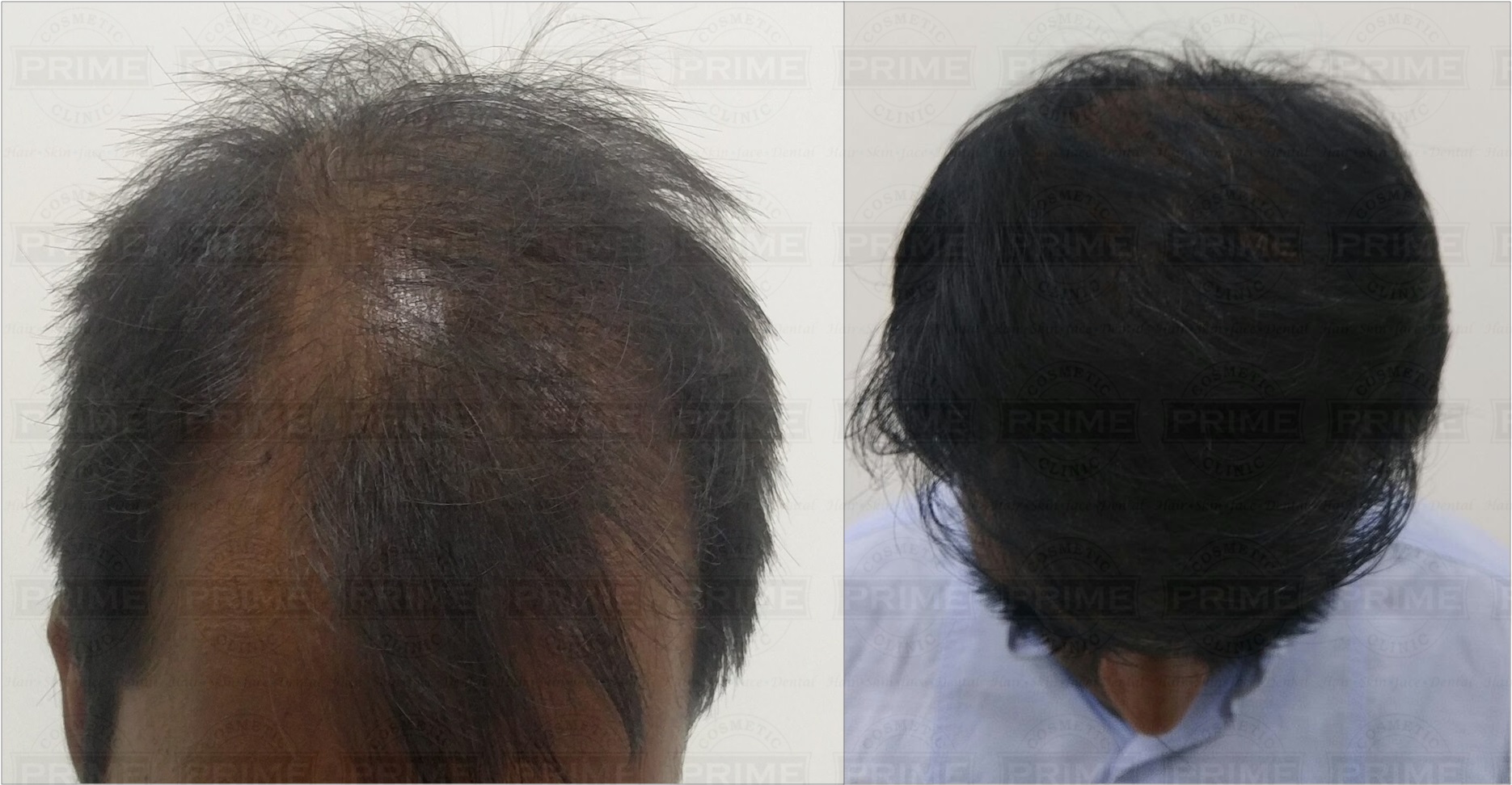 hair transplant in Mumbai