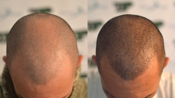 Benefits of trico-pigmentation over scalp micro-pigmentation | Scalp  tricopigmentation in Mumbai