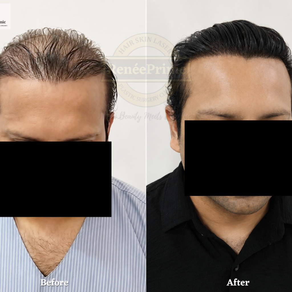 Biofibre Hair Transplant in Mumbai at Prime Clinic (ReneePrime Clinic)