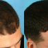 Benefits of PRP Treatment for  Hair in Mumbai