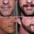 Different Styles of Beard Transplant you can opt for