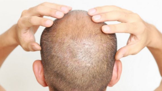 Hair Transplant Archives - Prime Hair Studio & Cosmetic Clinic