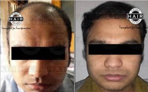 Hair Transplant in India Testimonial 15