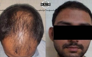 Hair Transplant in India Testimonial 18