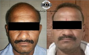 Hair Transplant in India Testimonial 19