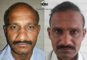 Hair Transplant in India Testimonial 2