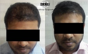 Hair Transplant in India Testimonial 20