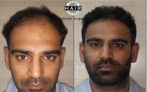 Hair Transplant in India Testimonial 21