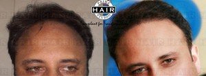 hair transplant cost- Prime Hair Studio