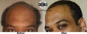 laser for hair loss-Prime Hair Studio