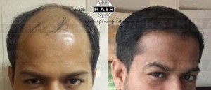 Treatment for Hair Loss - Prime Hair Studio